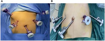 Complete laparoscopic and Da Vinci robot esophagogastric anastomosis double muscle flap plasty for radical resection of proximal gastric cancer